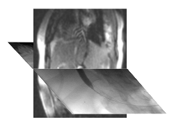 La imagen dual tomada con el sistema híbrido de obtención de imágenes por rayos X y RM desarrollado por científicos de Stanford muestra la expansión de un “stent” mediante balón en la radiografía (imagen horizontal) y el instrumento quirúrgico y el vaso sanguíneo que el médico está tratando en la imagen por RM (imagen vertical). Imagen cortesía de Rebecca Fahrig.
