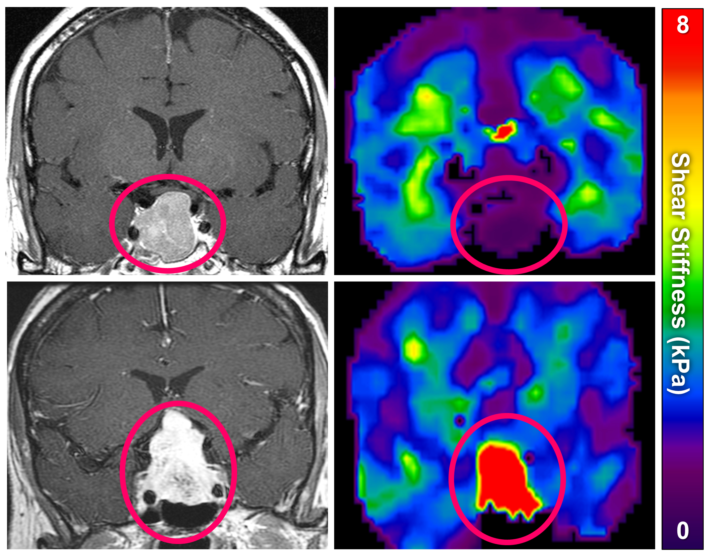 Elastograms showing stiff and soft pituitary tumors Elastograms showing stiff and soft pituitary tumors