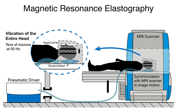 Illustration of magnetic resonance elastography, or MRE, a non-invasive technique used to measure the mechanical properties of biological tissue. Diagram shows how MRE is used to palpate tissue in the brain by sending shear waves through that tissue and measuring their displacement.