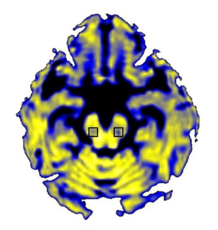 Brain MRI of Free Water