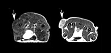 Two MRI images of breast cancer tumors. The more aggressive tumor is much brighter than the slow-growing tumor. 