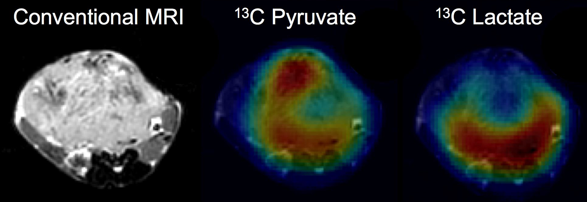 Although the conventional MRI (left) shows anatomic detail as to the extent of the tumor, the carbon-13 images show the uptake of the injected hyperpolarized pyruvate (middle) and its metabolic conversion to lactate (right). The data were acquired in 14 seconds and show high uptake of hyperpolarized pyruvate throughout much of the tumor. The lactate image shows high metabolic activity in the back of the tumor, which indicates biologically aggressive cancer. Aunque la resonancia magnética convencional (izquierda) muestra el detalle anatómico de la magnitud del tumor, las imágenes de carbono-13 muestran la absorción del piruvato hiperpolarizado inyectado (centro) y su conversión metabólica a lactato (derecha). La información fue adquirida en 14 segundos y muestra una alta absorción de piruvato hiperpolarizado por la mayor parte del tumor. La imagen de lactato muestra una alta actividad metabólica en la parte trasera del tumor, lo cual indica un cáncer biológicamente agresivo.