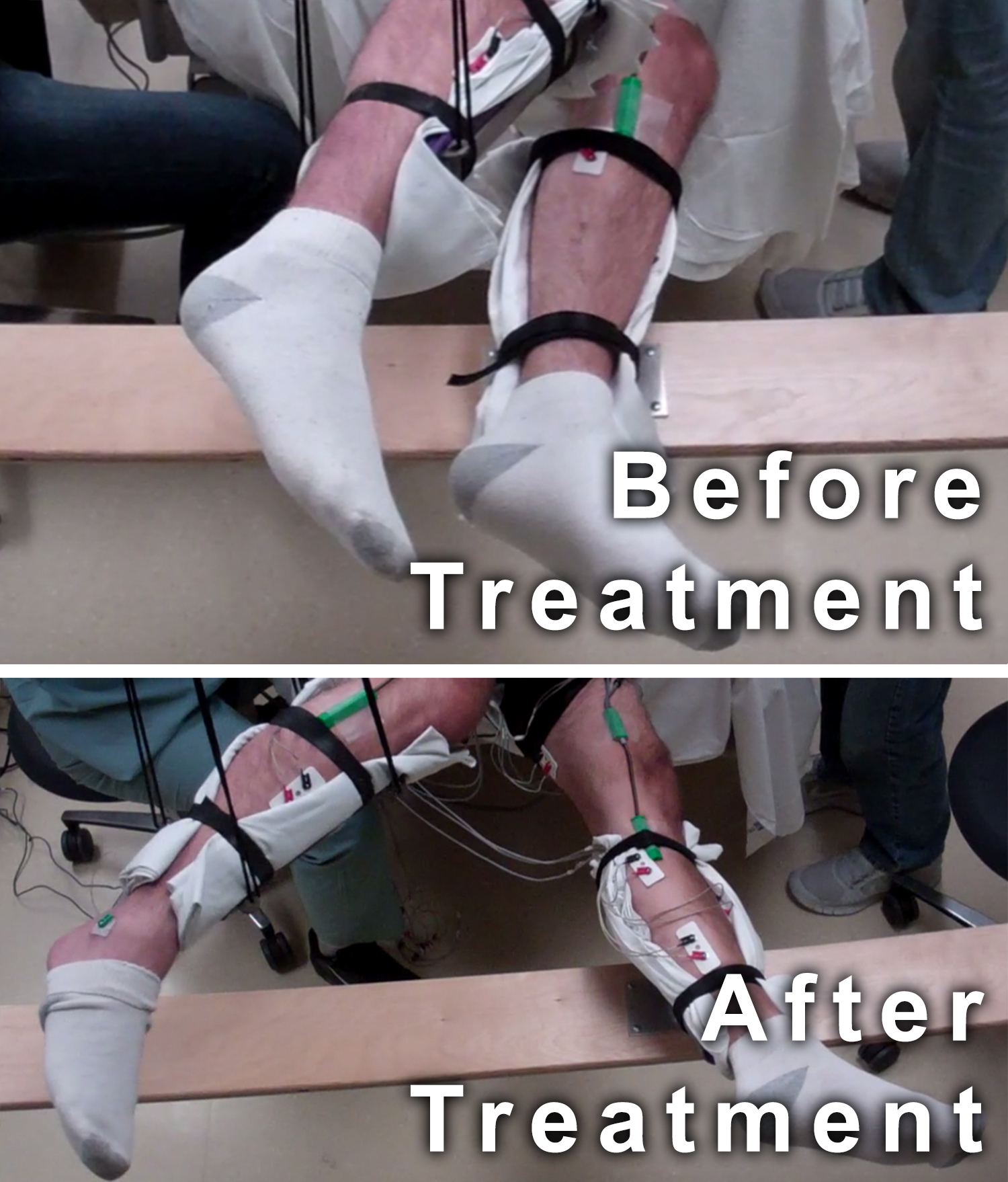 These two photos of the subject's legs suspended in braces show the change in the range of movement from before treatment and after treatment. In the before treatment photo, the subjects legs are positioned close together. In the after treatment photo, the feet are about four feet wide.