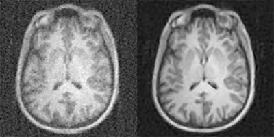 MRI of human brain