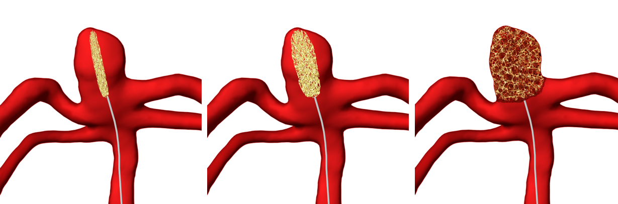 three panels showing expansion of shape memory foam in the artery