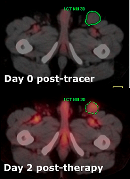 Superimposed SPECT and CT images show radioactivity uptake—red areas denote greater absorbed dose—on the day of the pre-treatment tracer dose and two days after the full treatment dose. The tumor is outlined in green.Source: Yuni Dewaraja, Ph.D., University of Michigan Superimposed SPECT and CT images show radioactivity uptake—red areas denote greater absorbed dose—on the day of the pre-treatment tracer dose and two days after the full treatment dose. The tumor is outlined in green.Source: Yuni Dewaraja, Ph.D., University of Michigan