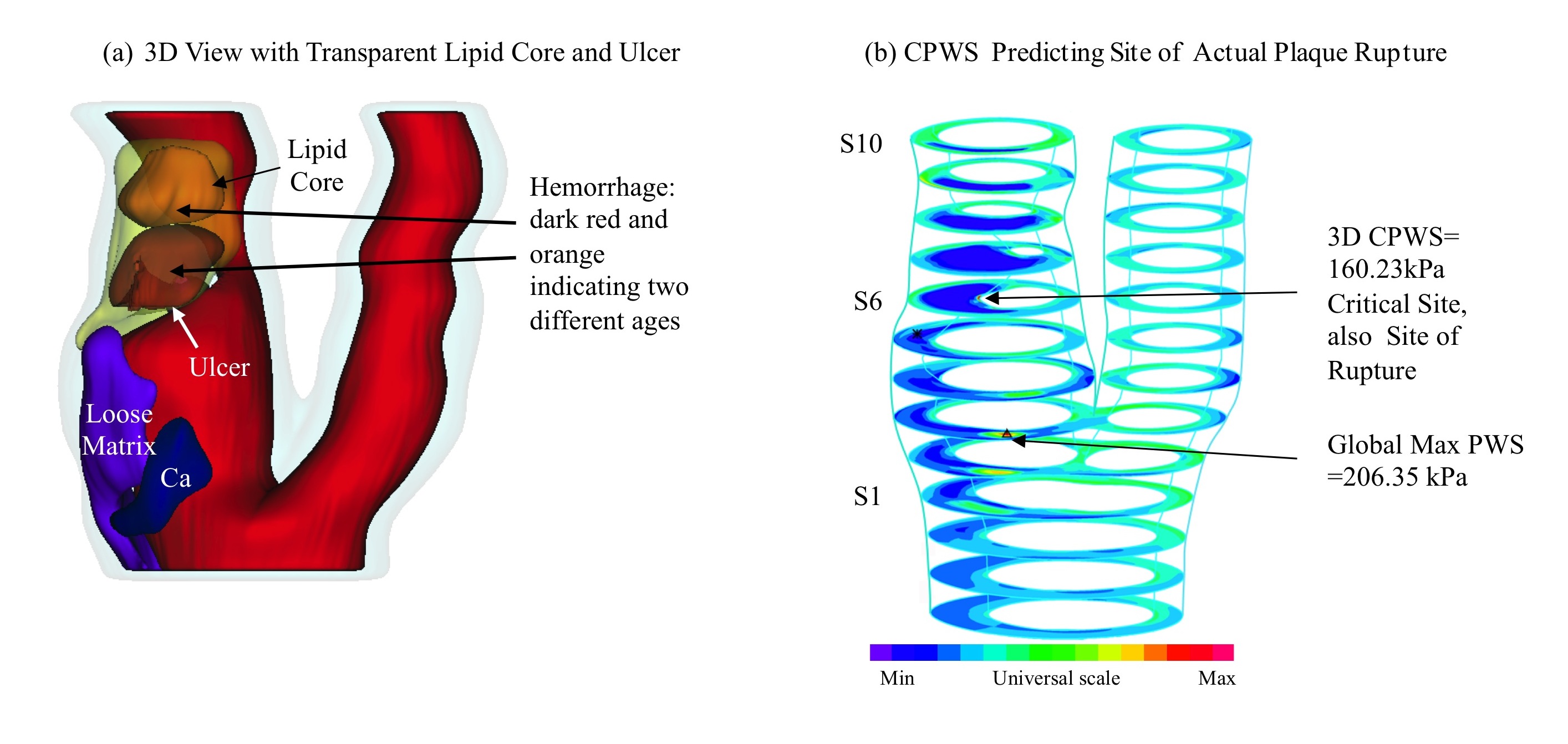 Esta vista 3D de una placa carótida humana muestra componentes de placa y la presencia de ulceración (a). Trazos de banda de la tensión en la pared de placa (Tensión-P1) muestran que la tensión crítica en la pared de placa en 3D (CPWS por sus siglas en inglés) predijo el sitio real de la ruptura (b)." title="Esta vista 3D de una placa carótida humana muestra componentes de placa y la presencia de ulceración (a). Trazos de banda de la tensión en la pared de placa (Tensión-P1) muestran que la tensión crítica en la pared de placa en 3D (CPWS por sus siglas en inglés) predijo el sitio real de la ruptura (b)