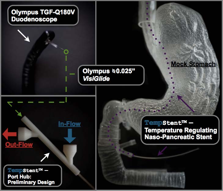 A photo of the TempStent in a model of the stomach