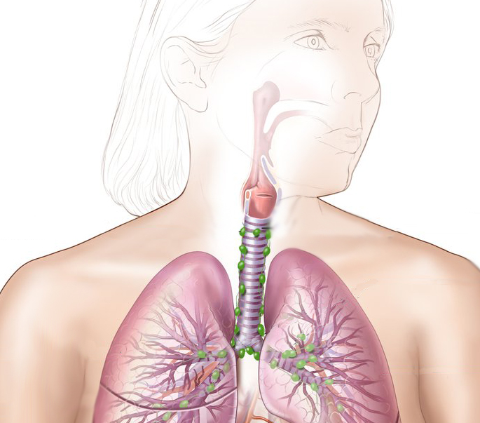 Medical illustration depicting respiratory system, highlighting lungs and trachea