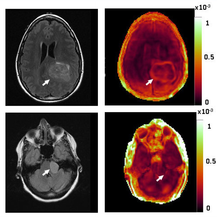 MRE indicates whether tumors are adherent (hard to remove) or non-adherent (easier to remove) MRE indicates whether tumors are adherent (hard to remove) or non-adherent (easier to remove)
