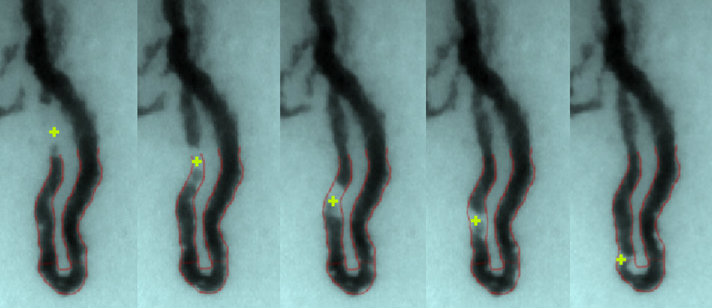 White blood cells flowing through finger capillary White blood cells flowing through finger capillary