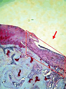 En sólo dos semanas, el cartílago – uno de los tejidos más difíciles de reparar – volvió a crecer en la rodilla de un conejo. El cartílago recién restaurado, teñido de púrpura oscura a la derecha, se reconstruyó utilizando un nuevo biomaterial que promueve el crecimiento de cartílago. Con más estudios, este biomaterial podría un día ayudar a reparar el cartílago dañado por lesiones.