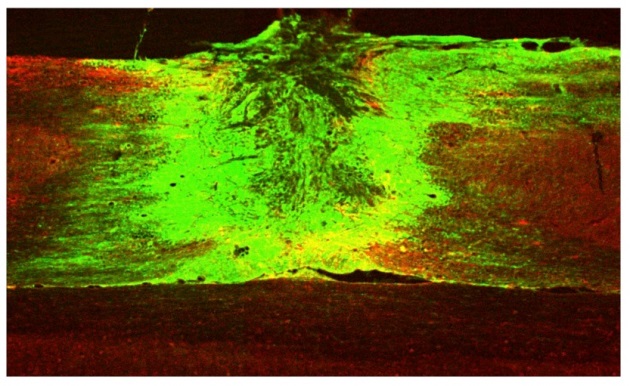 injured spinal cord with transplanted neurons growing our from site of transplanation