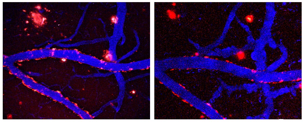 Longitudinal imaging of senile plagues during daily treatment with the curry spice component curcumin, which is a natural anti-oxidant and anti-inflammatory agent Longitudinal imaging of senile plagues during daily treatment with the curry spice component curcumin, which is a natural anti-oxidant and anti-inflammatory agent