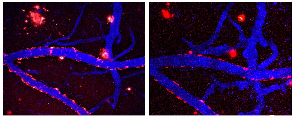 Estas imágenes representan la imagen longitudinal de placas seniles durante el tratamiento diario con el componente curcumina del curry, el cual es un agente natural anti-oxidante y anti-inflamatorio. La imagen a la izquierda muestra los depósitos amiloides marcados (rojos) antes del tratamiento, y la imagen a la derecha muestra el mismo volumen de imagen en el cerebro 7 días después de tratamientos sistémicos con curcumina. Los vasos sanguíneos se muestran en azul (angiografía con “Texas red dextran”). Note que las placas individuales se depuran o reducen dentro de este tiempo. Para más detalles, vea Garcia-Alloza et al., J. Neurochem., 2007.