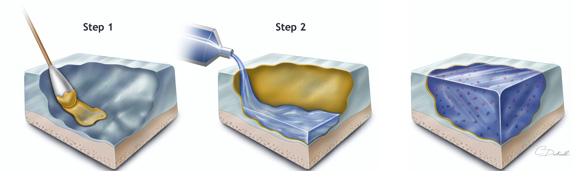 El adhesivo CS es aplicado a la superficie cartilaginosa con un hisopo (Paso 1). Se añade hidrogel encima del tejido tratado con el adhesivo y se polimeriza con luz. El adhesivo CS une químicamente el hidrogel al cartílago (Paso 2). Células formadoras de cartílago (rojo) se pueden incorporar en el hidrogel.