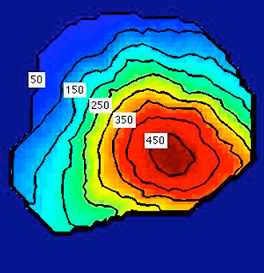 color coded map of radiation dose distribution in a tumor color coded map of radiation dose distribution in a tumor