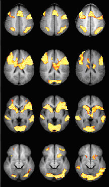 Los escáneres cerebrales de personas con un trastorno de lectura o ADHD muestran una mayor actividad cuando son tratadas con metilfenidato (columna central) en relación con las tratadas con placebo (columna izquierda). Se muestran los escáneres cerebrales de personas sanas para su comparación (columna derecha). Cortesía del Dr. Keith Shafritz, Centro Médico de la Universidad de Duke (Duke University Medical Center).