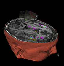 Los investigadores están desarrollando un sistema de obtención de imágenes que puede conducir a mejores tratamientos quirúrgicos para los pacientes con epilepsia. Esta imagen muestra la actividad normal del cerebro. Cortesía de la imagen del Dr. James Duncan, Yale University.