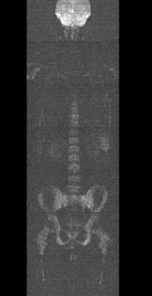 En esta imagen de resonancia magnética de un paciente de 20 años que tiene leucemia linfocítica aguda, lo que parecen ser imágenes de hueso son en realidad señales de la médula ósea que se piensa son causadas primordialmente por los linfoblastos leucémicos. Imagen cortesía de Douglas Ballon, Weill Cornell Medical College. 