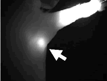 Image of quantum dots revealing the sentinel lymph node closest to a tumor. Image of quantum dots revealing the sentinel lymph node closest to a tumor.