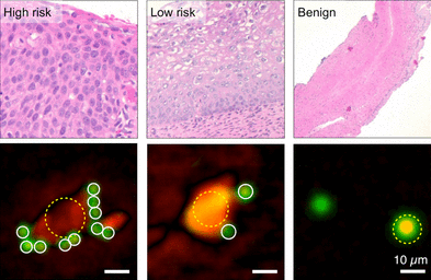 This is a figure showing cervical cancer diagnosis using the D3 platform. The top panel shows three different cervical tissue samples classified as either high-risk, low-risk, or benign using traditional pathology techniques, which require staining tissue and viewing it under a microscope. The bottom panel shows reconstructed images of cells and beads using the D3 platform. An increased number of bead-bound cells corresponded to a higher risk of cancer.