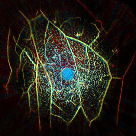 photoacoustic breast image photoacoustic breast image