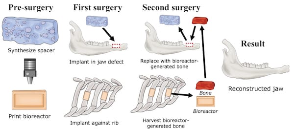 Four steps to grow bone and implant in jaw