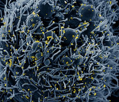 micrograph of  apoptotic cell infected with SARS-COV-2 virus particles