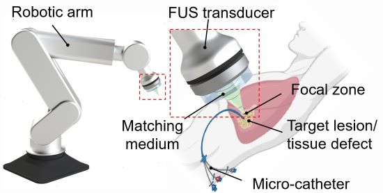 An illustration of a robotic arm connected to a focused ultrasound transducer that rests above a human chest. A microcatheter injects an ink into a region below the transducer.