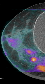 tämä on kuva TT-kuvasta, joka on otettu erityisellä sinus CT-kuvauksella ja jonka päälle on tehty PET-kuvaus, joka paljastaa korkean aineenvaihdunnan alueita, jotka viestivät erilaisista kasvaimista