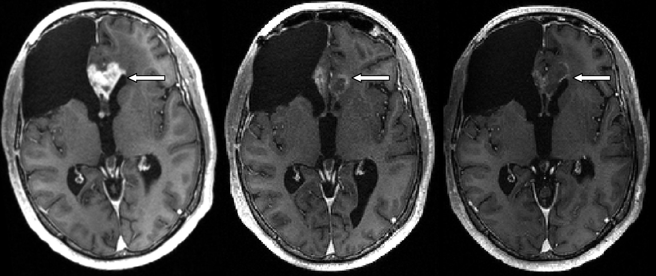 Example of the abnormal vessel “tortuosity” (abnormal wiggles in the vessels) seen in the presence of cancer (left) and the straightening out of the same vessels following successful treatment (right). Vessel images were extracted from MRA scans performed approximately 6 weeks apart. Note that the vessels on the left exhibit many smaller bends upon each larger bend. The patient shown did well clinically for almost a year.