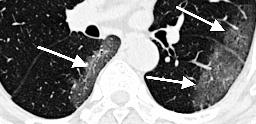 CT scan of COVID-19 lungs