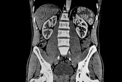 CT scan of the abdomen