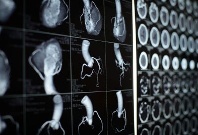 Summary of Results Using the Three-Dimensional Computed Tomographic