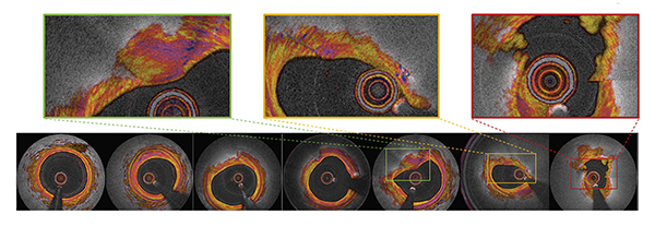 Newswise: First-in-human pilot imaging study shows improved heart attack prediction