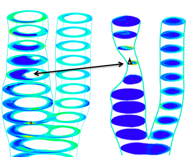 There are two images. On the left is a model of critical plaque wall stress. On the right is a model of the maximum flow shear stress which predicts atherosclerotic plaque rupture. Source is Dalin Tang from Worcester Polytechnic Institute.