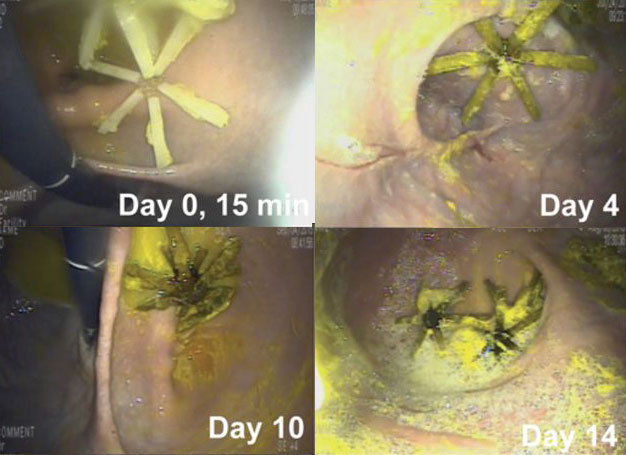 A series of four photos showing the disintegration of the new drug delivery system over the course of two weeks.