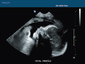 This is a picture of a fetal ultrasound