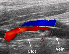 This is an image of a pig blood vessel blocked by a clot as visualized using color Doppler ultrasound. The red corresponds to blood flow and there is less red around where the clot is present.