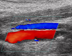 This is picture of an Doppler color ultrasound showing restoration of blood flow following histotripsy.