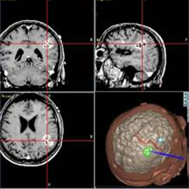 Tres cortes de imagen por RM de un cerebro y una imagen tridimensional de un cerebro