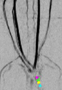 Imagen por resonancia magnética que muestra los instrumentos quirúrgicos dentro de un paciente y un coágulo de sangre