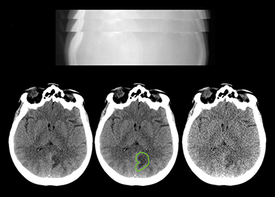 CT imaging of a person's head