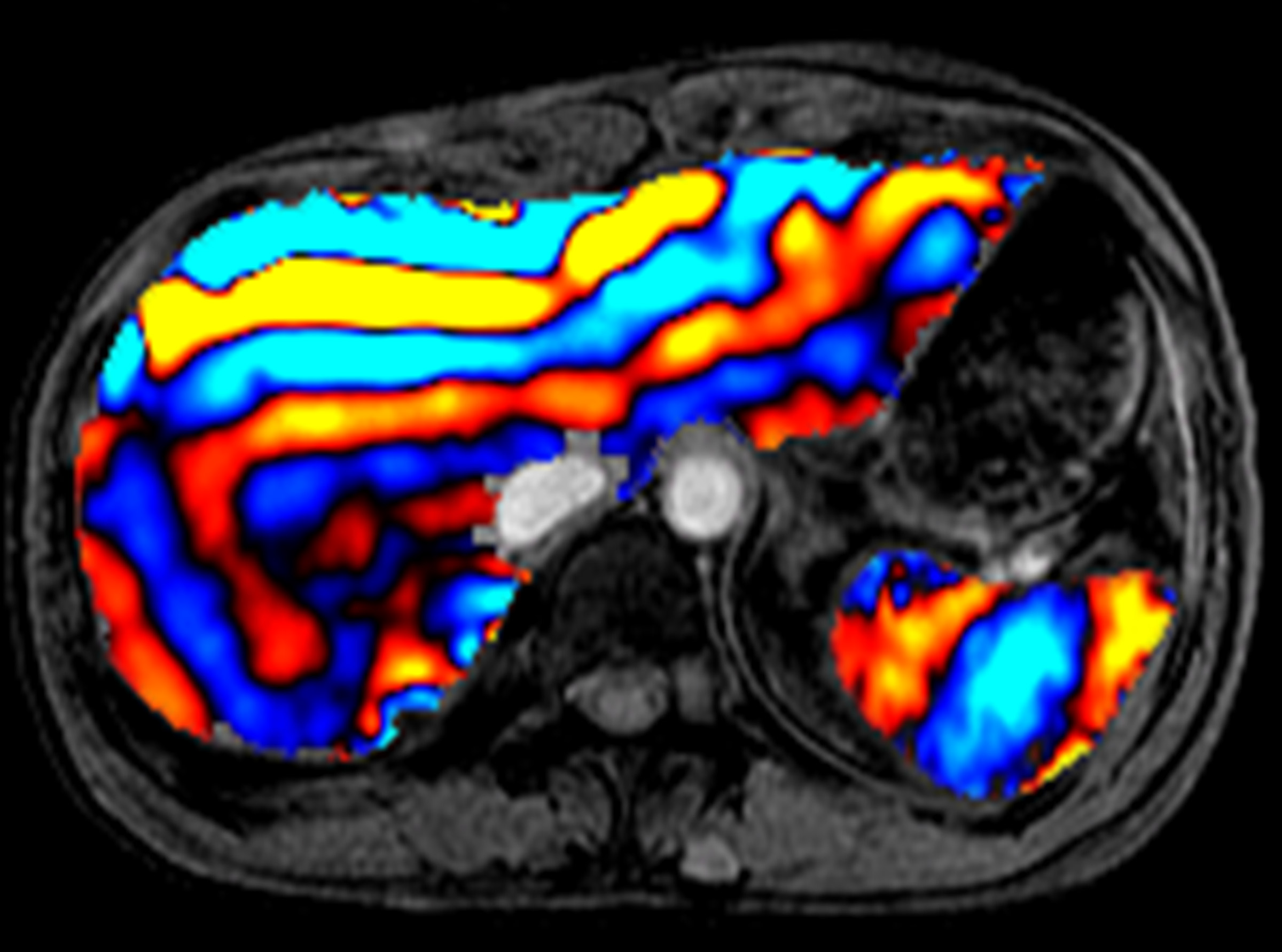 This is an image of the liver using magnetic resonance elastography. It is multicolored and different colors correspond to the different stiffness of the tissue