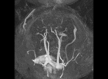 A rotating magnetic resonance angiography, or MRA, image of the vasculature of the brain.