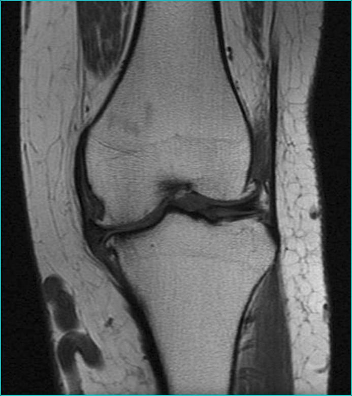 Imagen por IRM de una rodilla