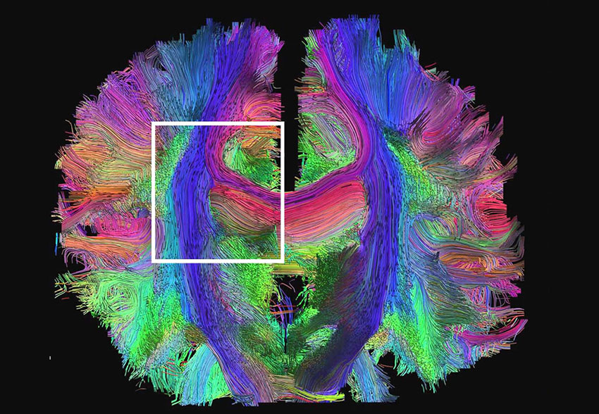 Hilos de colores representan las múltiples conexiones dentro del cerebro