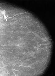 Esta es una imagen de un mamograma mostrando una pequeña lesión cancerosa