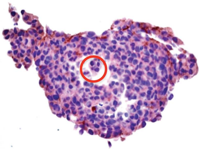 Staining of tumor organoid removed from bioreactor system